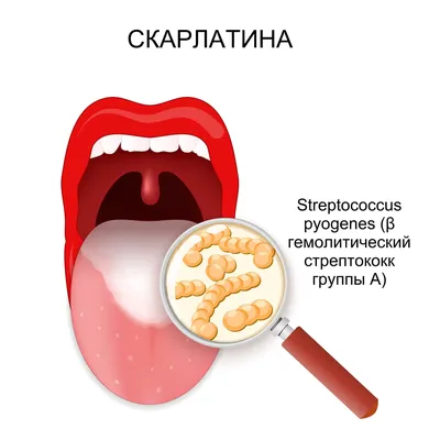 Скарлатина: лечение, причины, симптомы и вакцинация