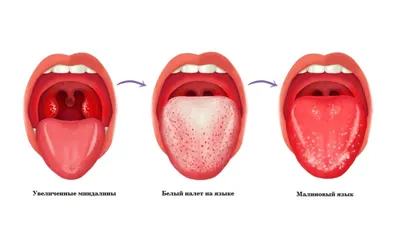 Скарлатина - причины появления, симптомы заболевания, диагностика и способы  лечения