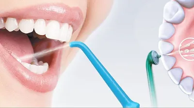 Химическая чистка зубов | Стоматология "Имплант-Эксперт" | Дзен