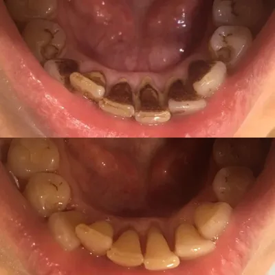Особенности ультразвуковой чистки зубов - Стоматология Май