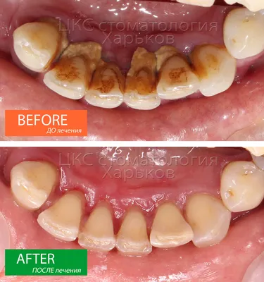 Профессиональная чистка зубов у стоматолога - Лазерная чистка зубов