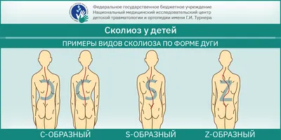 Как лечить сколиоз дома? Советы реабилитолога, физического терапевта