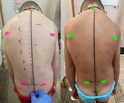 Степени сколиоза и их лечение в Москве | Отделение детской костной  патологии и ортопедии ЦИТО
