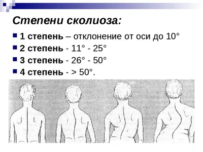 Сколиоз 3 степени. Лечение искривления позвоночника в СПб