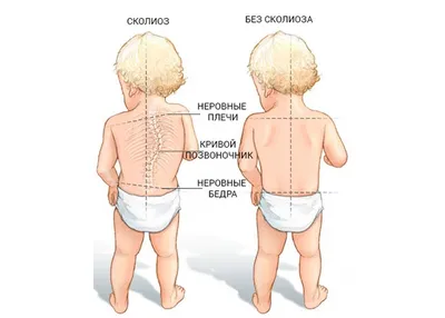 Сколиоз: фото, 1, 2, 3 и 4 степени, у детей, лечение, упражнения