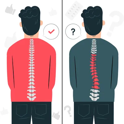 Сколиоз: этиология, классификация, диагностика, лечение - Vertebra