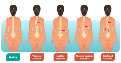 Сколиоз: степени искривления позвоночника и грудопоясничного отдела,  причины, симптомы, лечение в клинике Константа в Ярославле