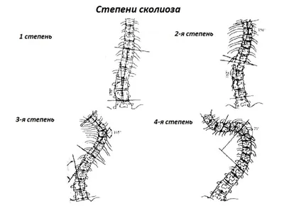 Стадии развития сколиоза позвоночника у детей - Доктор Позвонков