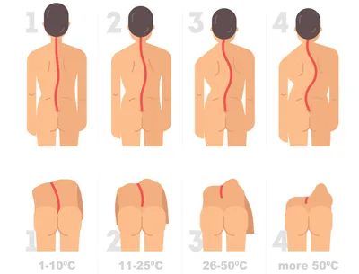 Сколиоз позвоночника у детей и взрослых лечение. Сколиоз 1, 2 степени, как  лечить.