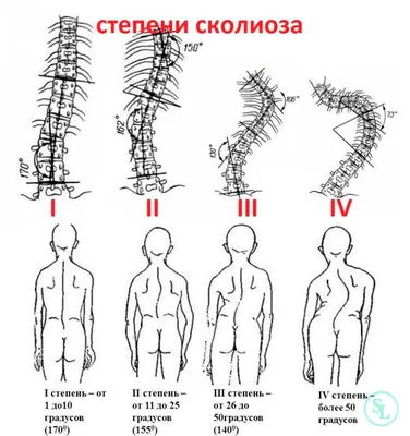 СКОЛИОЗ позвоночника 1, 2, 3 и 4 степени у детей и взрослых - симптомы,  причины, диагностика |  | Дзен