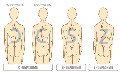 S-образный сколиоз - фото ДО и ПОСЛЕ лечения