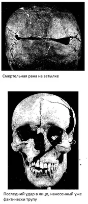 Мукормикоз: черный грибок, из-за которого переболевшие Covid-19 в Индии  лишаются глаз - BBC News Русская служба