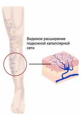 Варикозная болезнь: причины, симптомы, лечение и профилактика