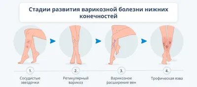 Почему отекают ноги. Отек голени или щиколотки - к какому врачу обращаться?