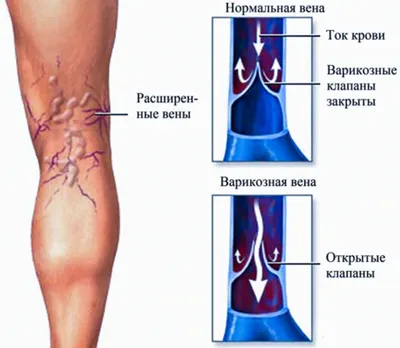 Заболевания сосудов ног. Удаление сосудистых звездочек, лечение синяков на  ногах.