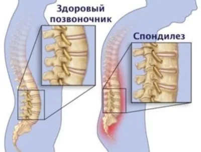 Спондилез - причины, симптомы, диагностика и лечение