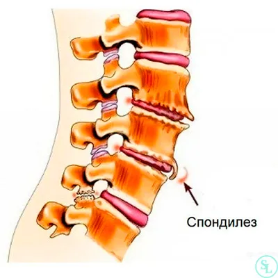 Спондилёз — Википедия
