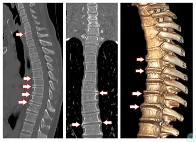 Спондилез грудного отдела позвоночника: особенности и деформирующий  характер заболевания