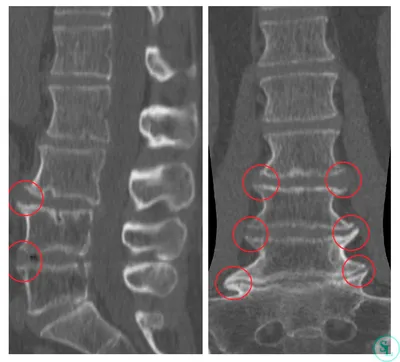 Спондилез и спондилолиз - различия и методы лечения