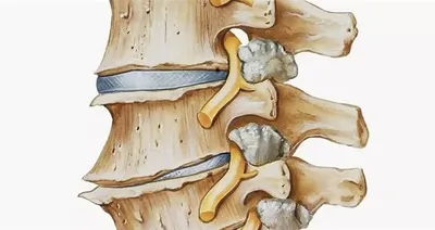 Спондилёз: лечение, симптомы, причина | Ист Клиник | Дзен
