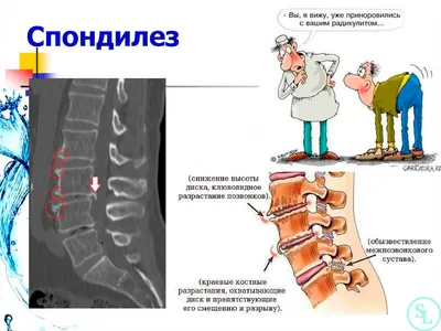 Лечение спондилеза 1, 2, 3 степени в центре Ист Клиник в Москве. Шейного,  поясничного, грудного отдела.