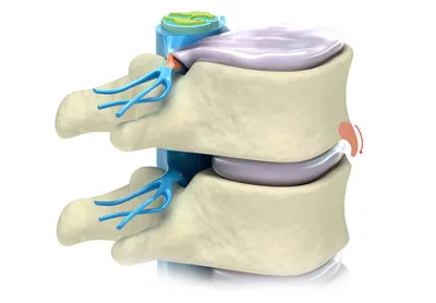 Деформирующий спондилез - симптомы, диагностика, лечение | Медицинский  центр ДА!