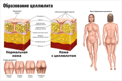 Целлюлит. ТОП-5 процедур против целлюлита