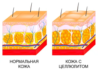 Как избавиться от целлюлита эффективно и окончательно — спроси у Cocos