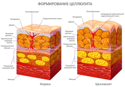 Целлюлит. Стадии целлюлита | Твоя фея крестная в похудении | Дзен