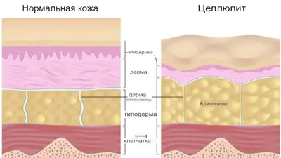 Целлюлит - описание, симптомы, причины и лечение