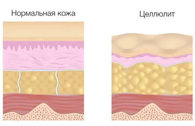 Три стадии целлюлита и методы борьбы с ними