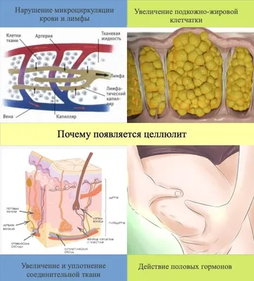 Как избавиться от целлюлита | Дарья П | Дзен