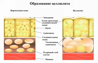 Cредства от целлюлита: лучшие и самые эффективные средства, которые помогут  избавиться от целлюлита