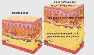 Дренажная щётка RICHE для сухого массажа из кактуса и дуба - «От 3 стадии  целлюлита ко 2 стадии за месяц! Фото до и после на разных зонах.» | отзывы