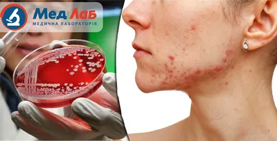 Стафилококк на лице: причины, способы лечения и советы переболевших |  7Дней.ru