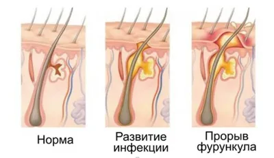 Стафилококк на лице: причины появления и способы удаления | WDAY