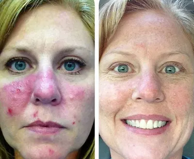 Экзема на лице: лечение народными средствами, фото, причины возникновения,  как она выглядит на коже у женщин