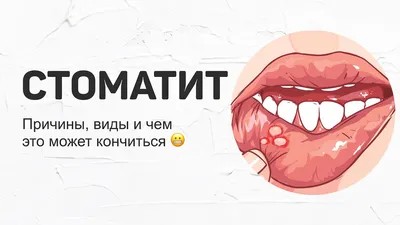 Афтозный стоматит: симптомы, причины и лечение - Альянс бьюти-стоматологов,  Москва