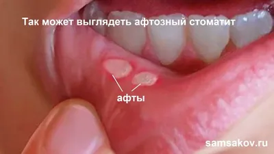 Афтозный стоматит – что это, лечение, виды, причины и симптомы