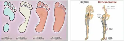 Про стопы ног и про болезни, которые по стопам можно определить. | Моя  копилка. | Дзен