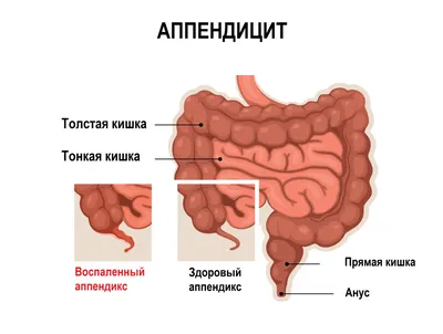 Колоректальный рак: симптомы, признаки, лечение, прогно