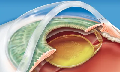 Хрусталик глаза: строение, функции, заболевания и лечение