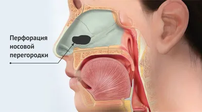 Перфорация перегородки носа: симптомы, лечение, реабилитация