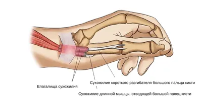 Повреждение сухожилий разгибателей пальцев и кисти - KinesioPro