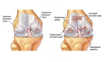 Деформации коленных суставов: разбираемся с экспертом ННИИТО | «ННИИТО им.  Я.Л.Цивьяна» Минздрава России