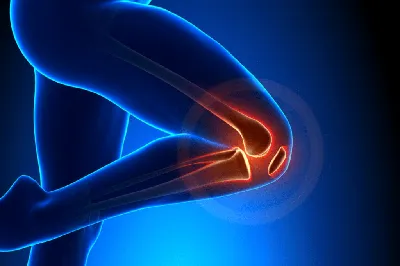 Артрит коленного сустава: симптомы и лечение - статьи от компании Еламед