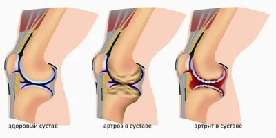 Артрит и артроз – в чем разница?