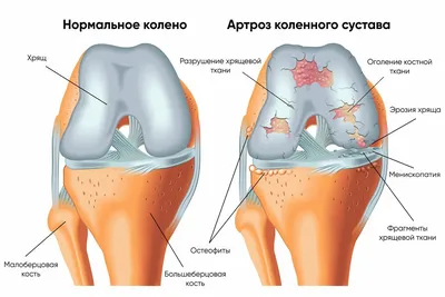 Эндопротезирование коленного сустава в Германии