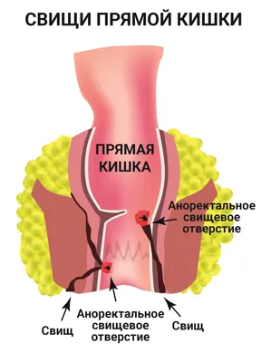 Киста копчика. Эпителиальный копчиковый ход. - YouTube