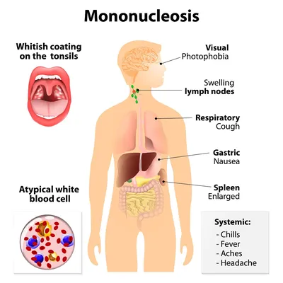 Диета при мононуклеозе у детей: правильное питание для быстрого  восстановления